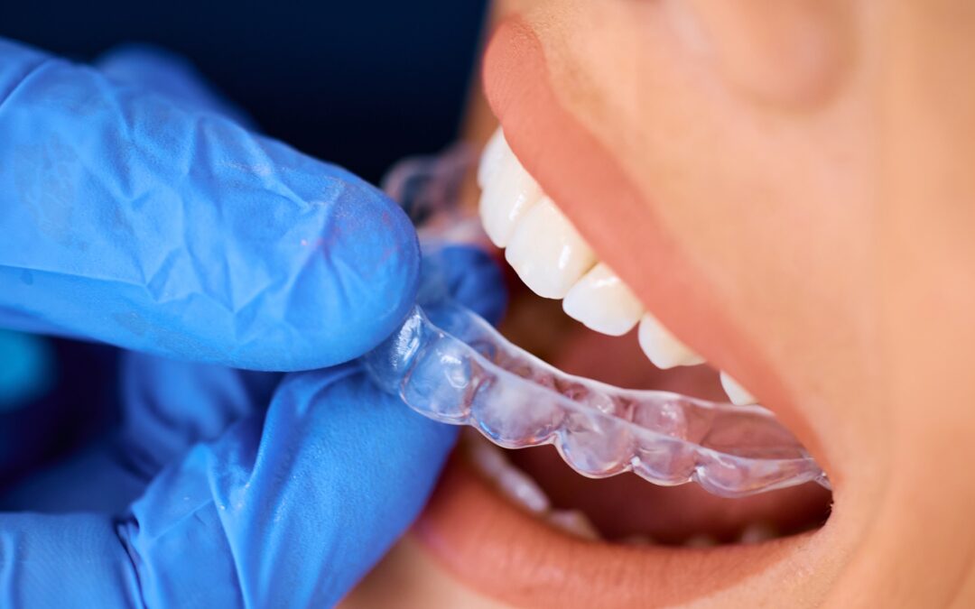 SimplyClear Braces vs. Traditional Braces: What’s Right for You?