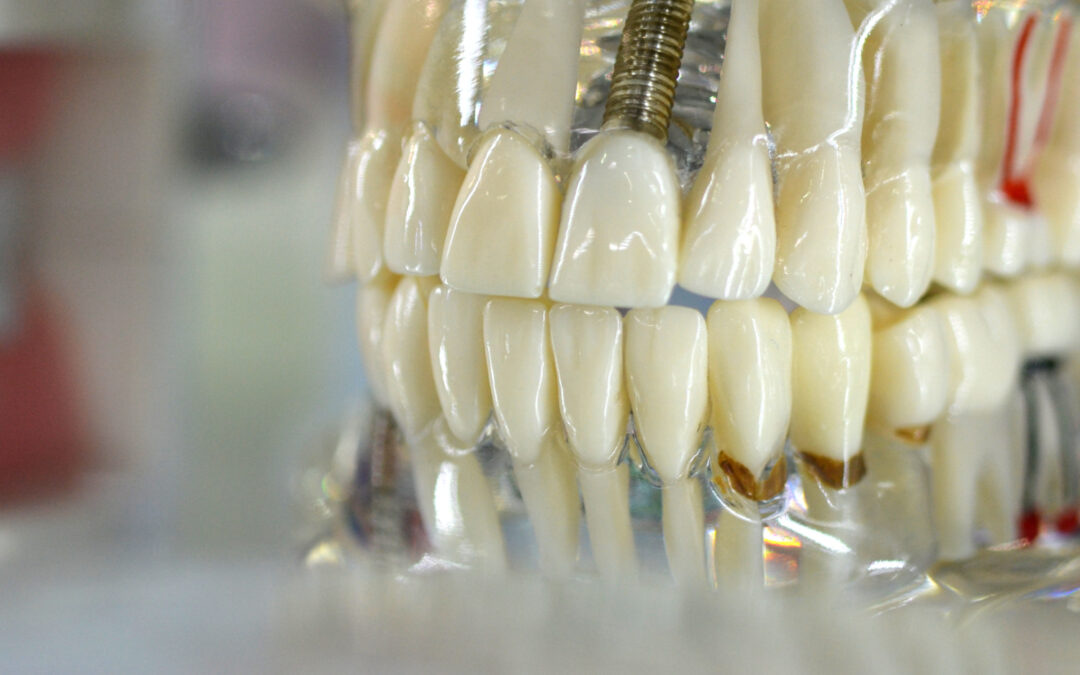 Are Dental Implants the Right Choice for You?