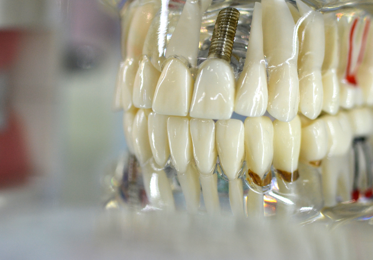 Dental Implants