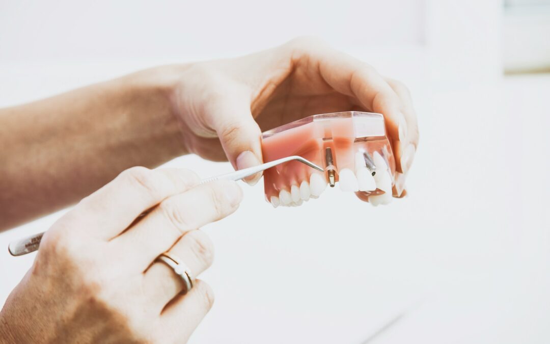 Revolutionizing Your Smile with the Help of Dental Implants